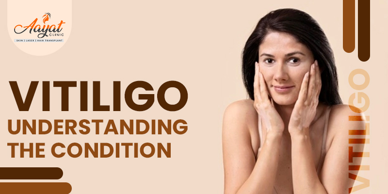 Vitiligo: